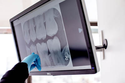 large screen at Dentistry by the Bay showing a patient's dental x-rays
